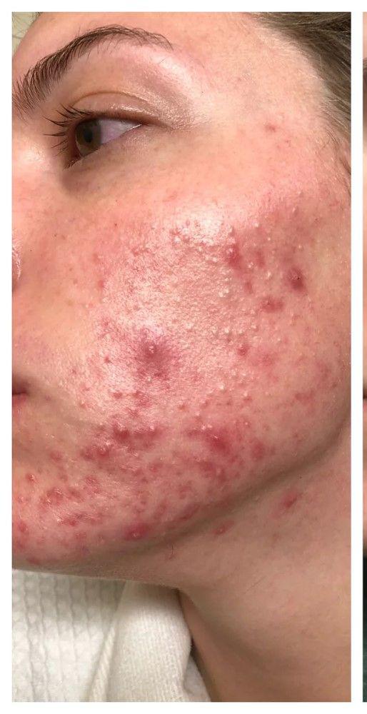 image comparison before