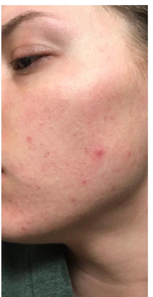 image comparison after